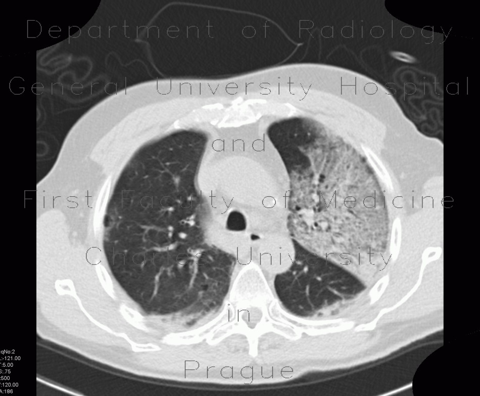 Pneumocystis pneumonia, PCP, Pneumocystis carinii