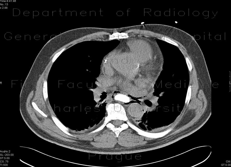 Pneumomediastinum