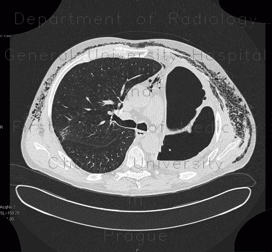Pneumonectomy, hematoma of the pleural cavity, subcutaneous emphysema