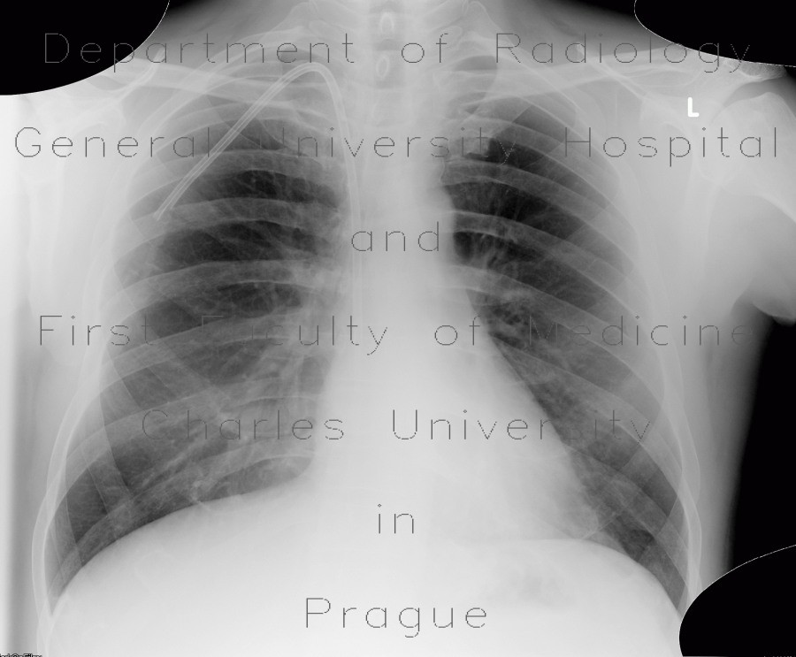 Pneumonia