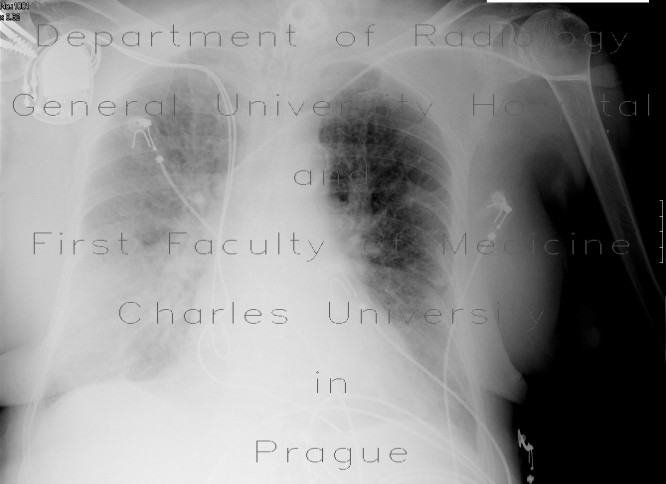 Pneumonia