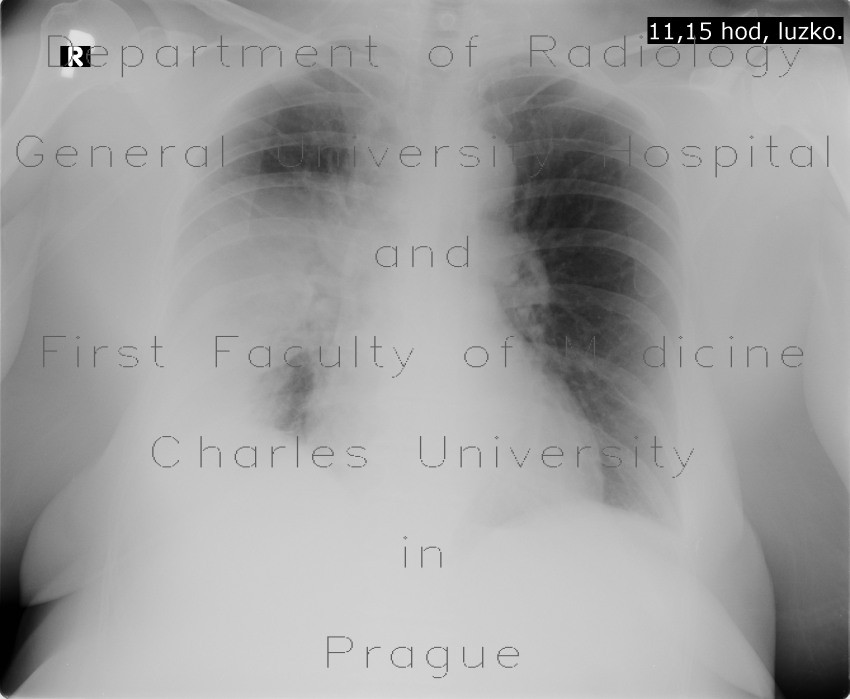 Pneumonia, abscess, bronchiectasis
