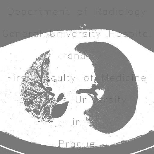Pneumonia, bronchiectasis