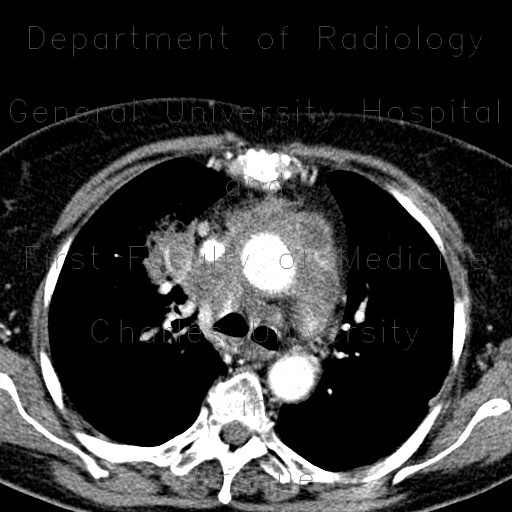 Pneumonia, mediastinitis, mediastinal abscess