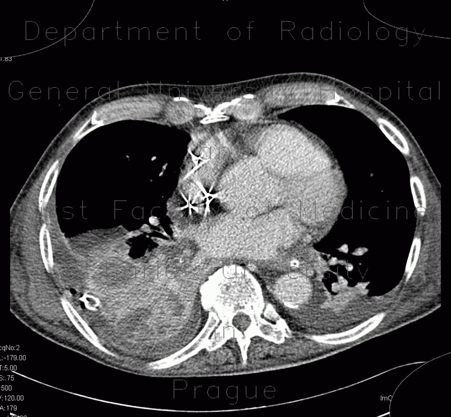 Pneumonia, panlobular emphysema, fluid-filled bullae