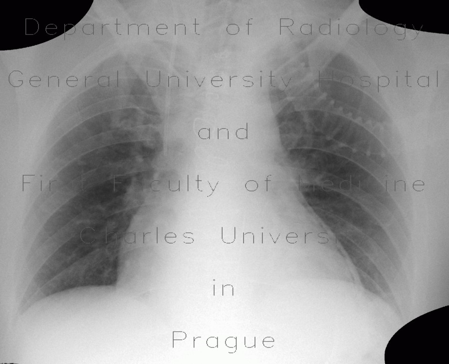 Pneumopericardium, postoperative
