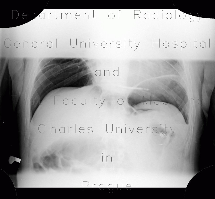 Pneumoperitonum after EPE, endoscopic polypectomy, complication, hemoclips