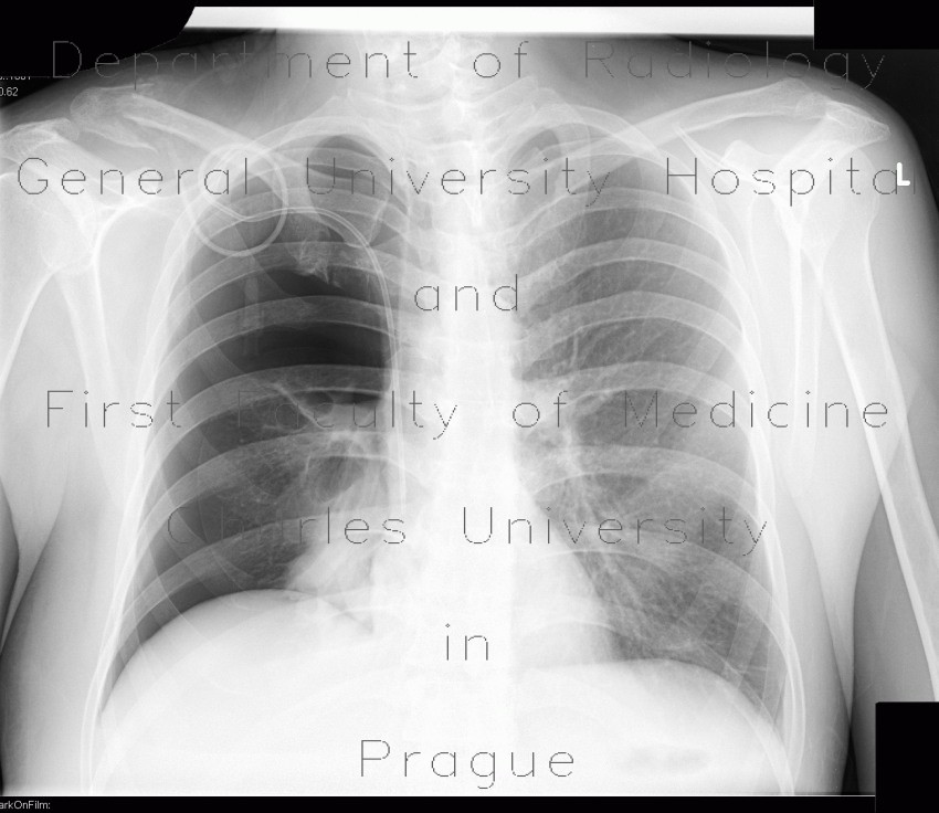 Pneumotorax