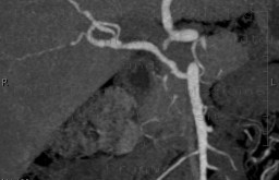 Polyarteritis nodosa