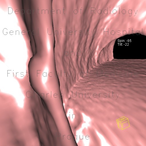Polyp, diminutive lesion, ascending colon, CT colonography
