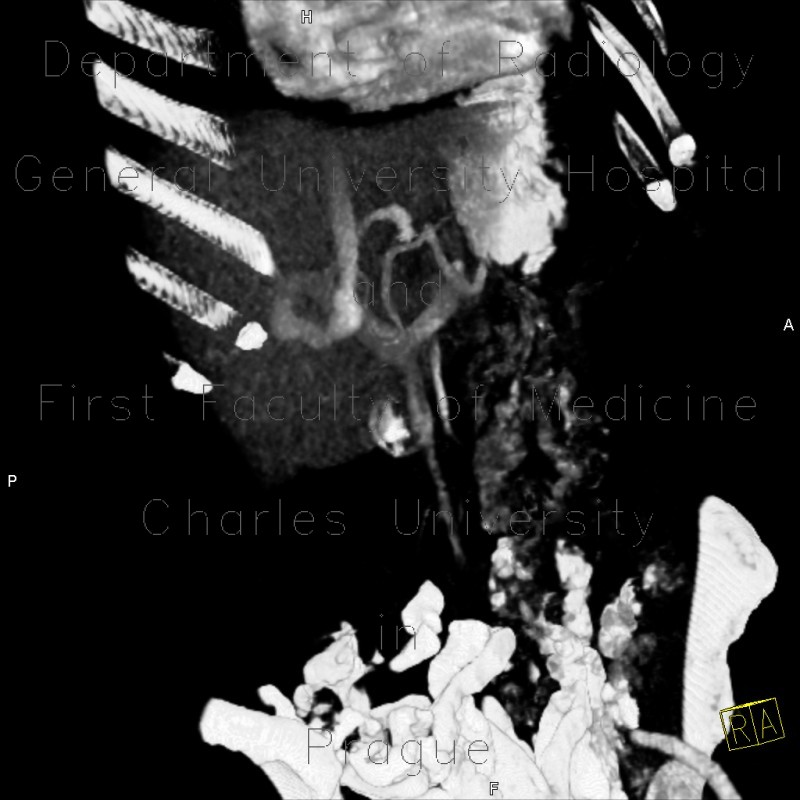 Portocaval shunt in liver, VRT