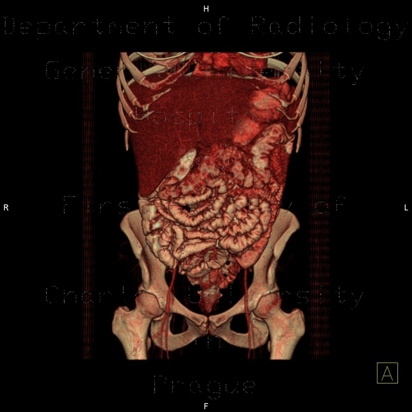 Post-radiation enteritis, enterography, positive contrast, VRT