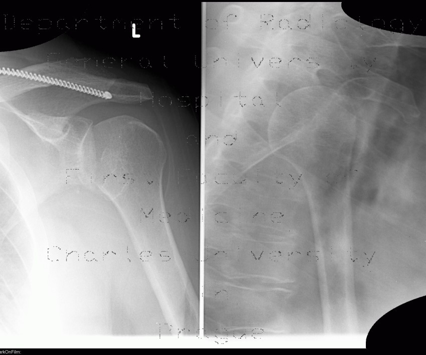 Posterior dislocation of glenohumeral joint