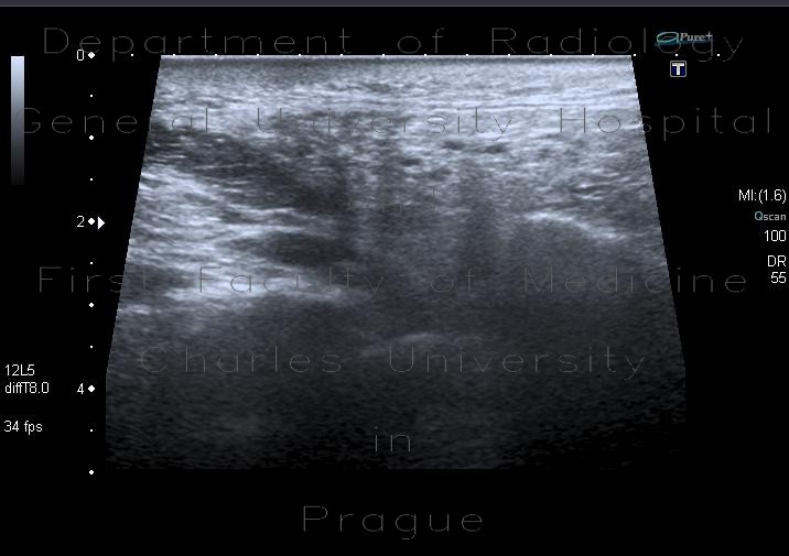 Postirradiation changes of submandibular region and lymph nodes