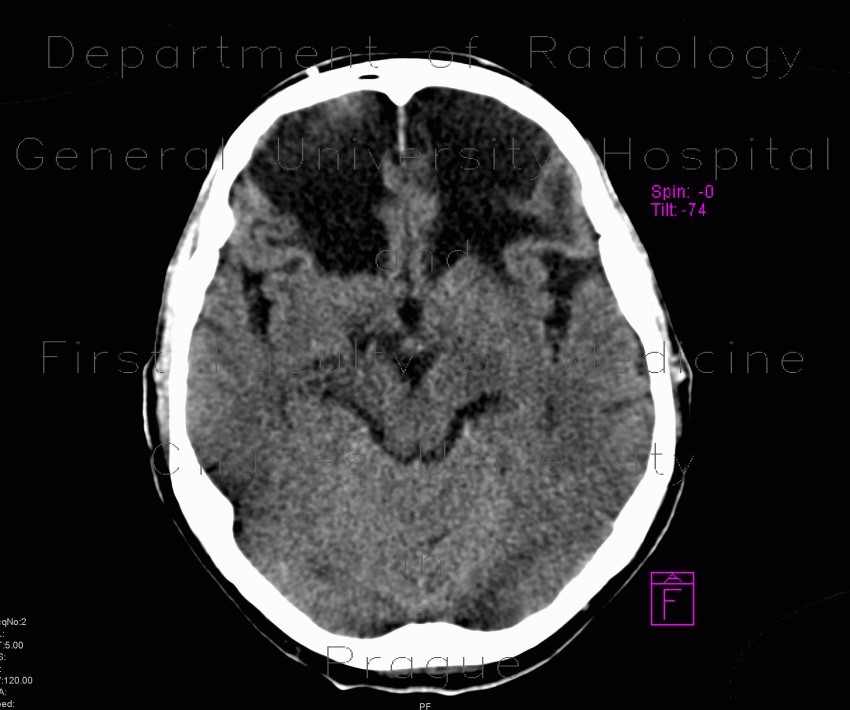 Postischemic changes in frontal lobes