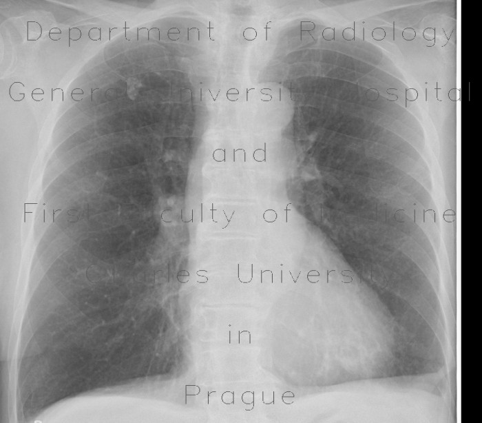 Postspecific nodule in lung