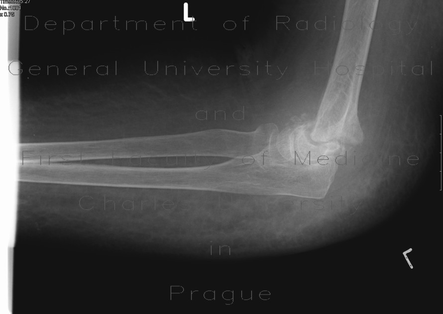 Pseudoarthrosis of humerus, supracondylic fracture