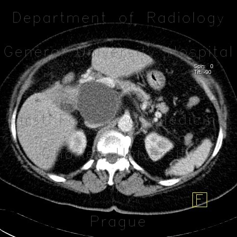 Pseudocyst of pancreas, compression of bile duct