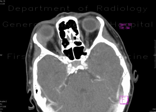 Pseudotumour of lacrimal gland