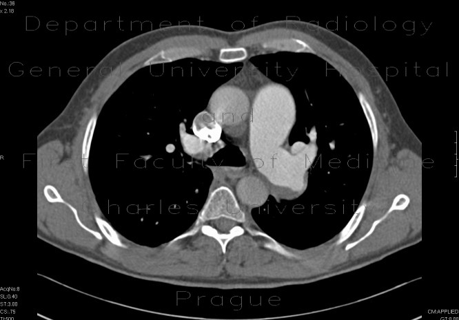 Pulmonary embolism, thrombolysis