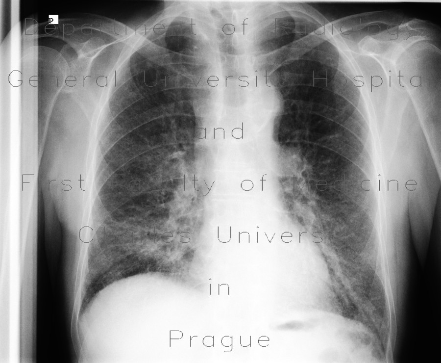 Pulmonary fibrosis, rheumatoid arthritis