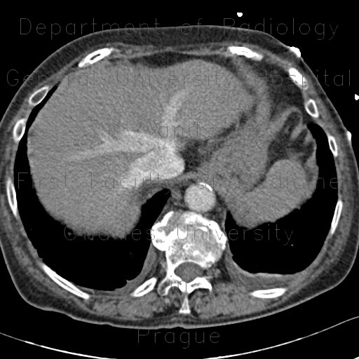 Pulmonary hypertension