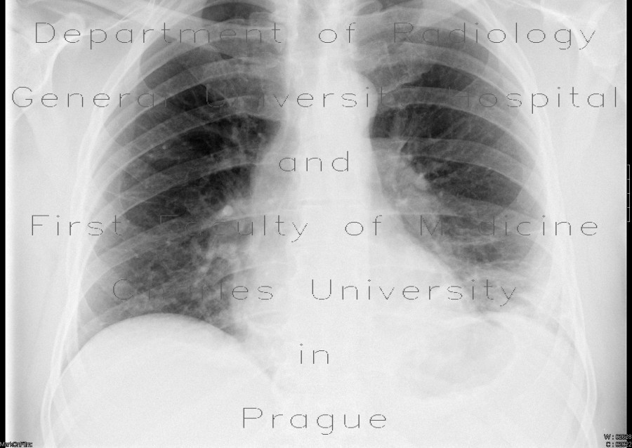 Pulmonary infarction, pulmonary embolism