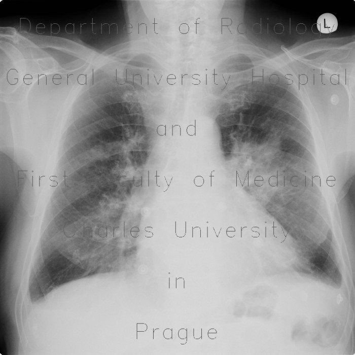 Pulmonary infiltrates, pleural effusion