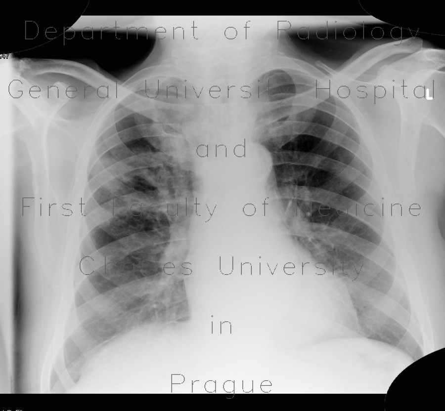 Pulmonary tuberculosis, TBC, tuberculosis