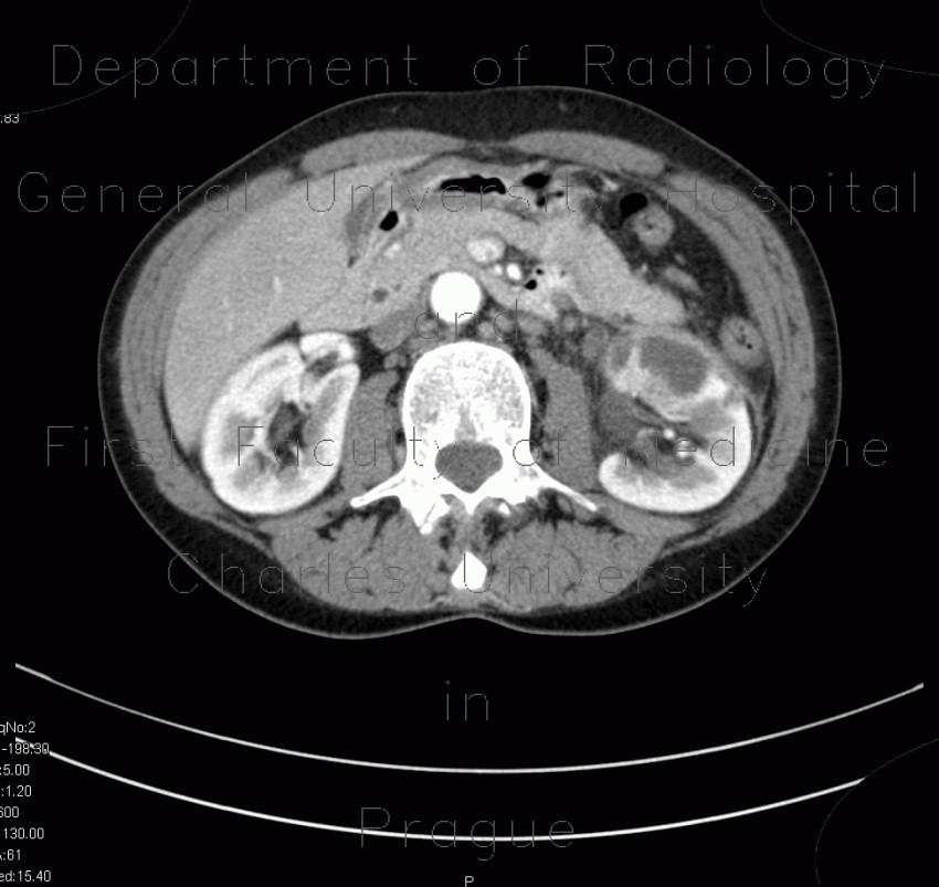Pyelonephritis
