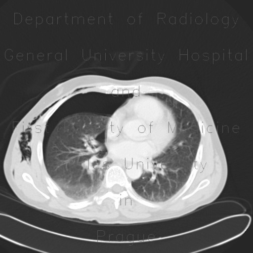 RTA, pneumothorax, subcutaneous emphysema, soft tissue damage, fracture of iliac crest, rib fracture