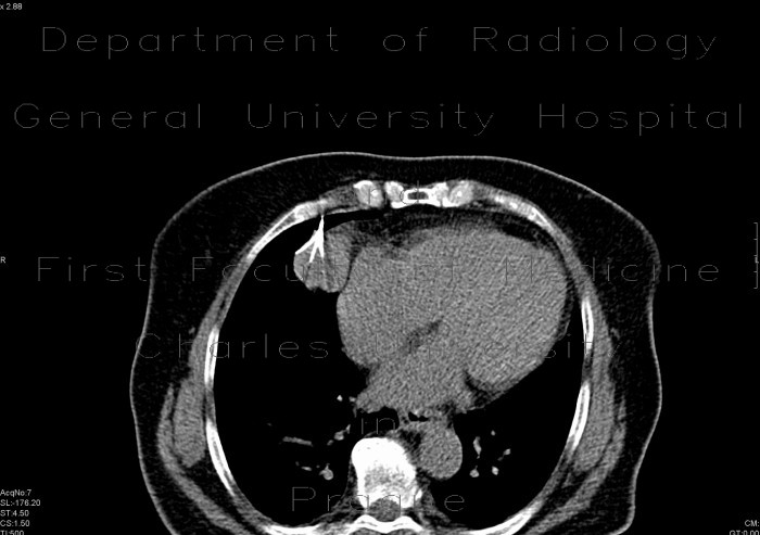 Radiofrequency ablation, RFA, mediastinal tumour