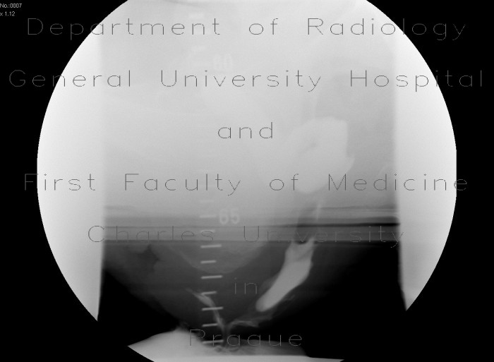 Rectal prolapse