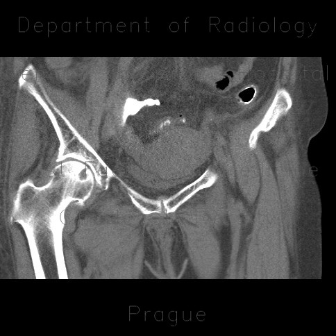Rectovaginal fistula