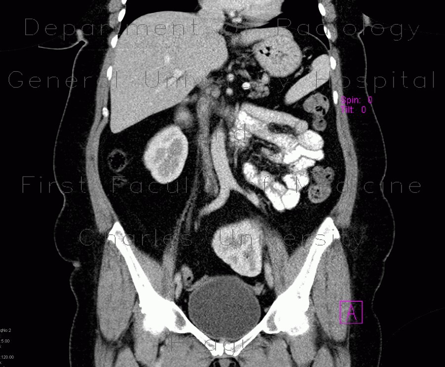 Ren migrans, moving kidney, ectopic kidney