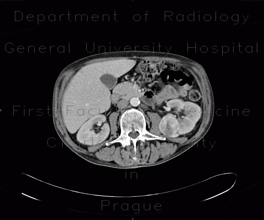Renal carcinoma, correlation of ultrasound and CT