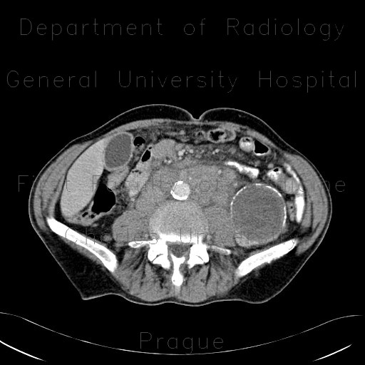 Renal carcinoma, cystic, retroperitoneal lymphadenopathy