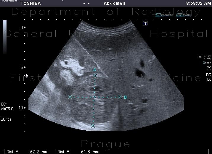 Renal cell carcinoma
