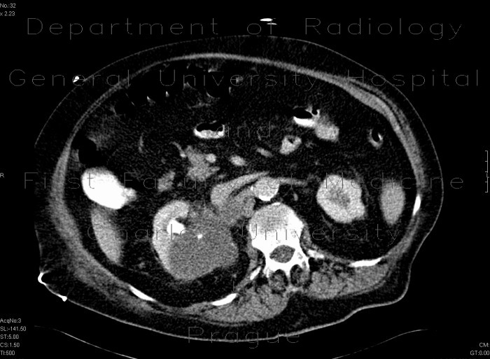 Renal cell carcinoma, atypical