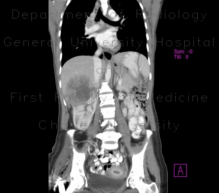 Renal cell carcinoma, infiltration of liver