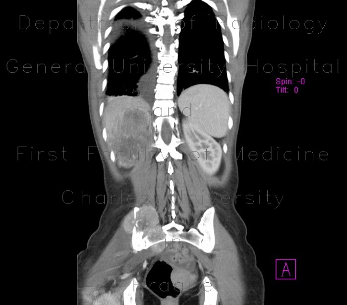 Renal cell carcinoma, metastasis into pelvis