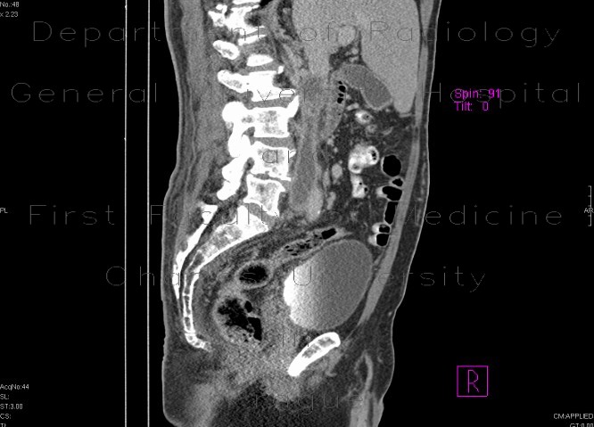 Renal cell carcinoma, thrombosis of the inferior vena cava