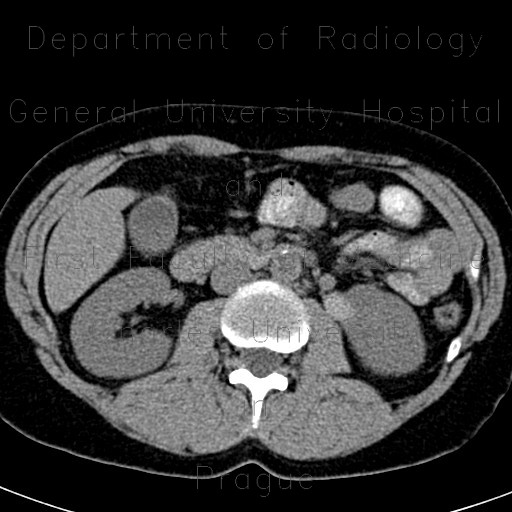 Renal cyst, complicated cyst