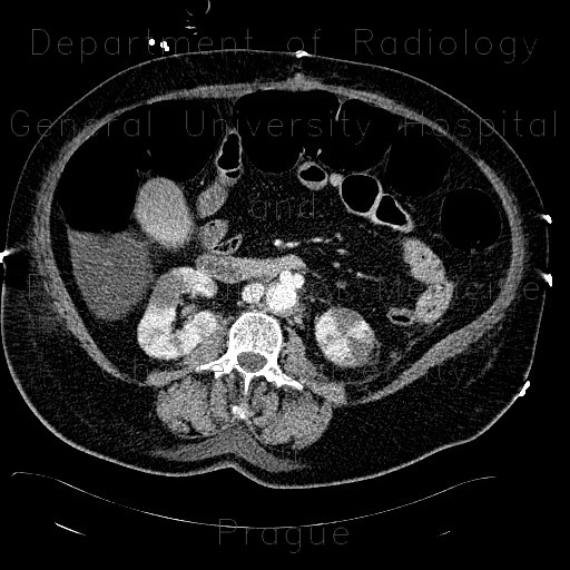 Renal infarction, biliary excretion of contrast
