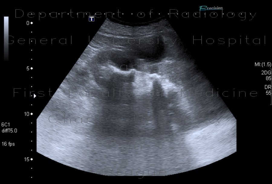 Renal stones, nephrolithiasis, casting stones, staghorn calculus