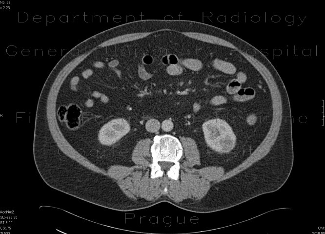 Renal tumour, small