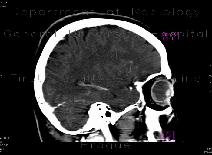 Retinal detachment