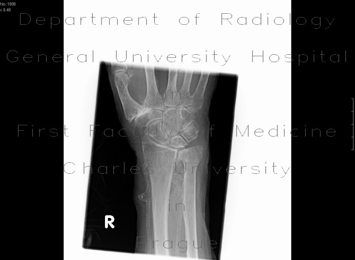 Rhizarthrosis, mediocalcinosis