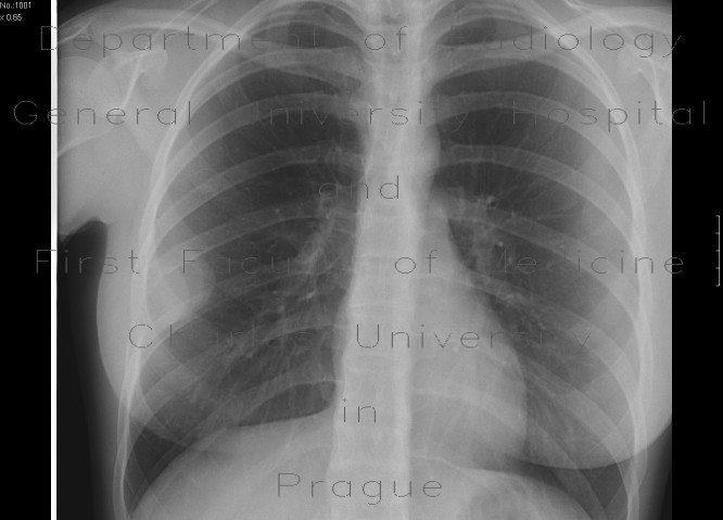 Rib tumour