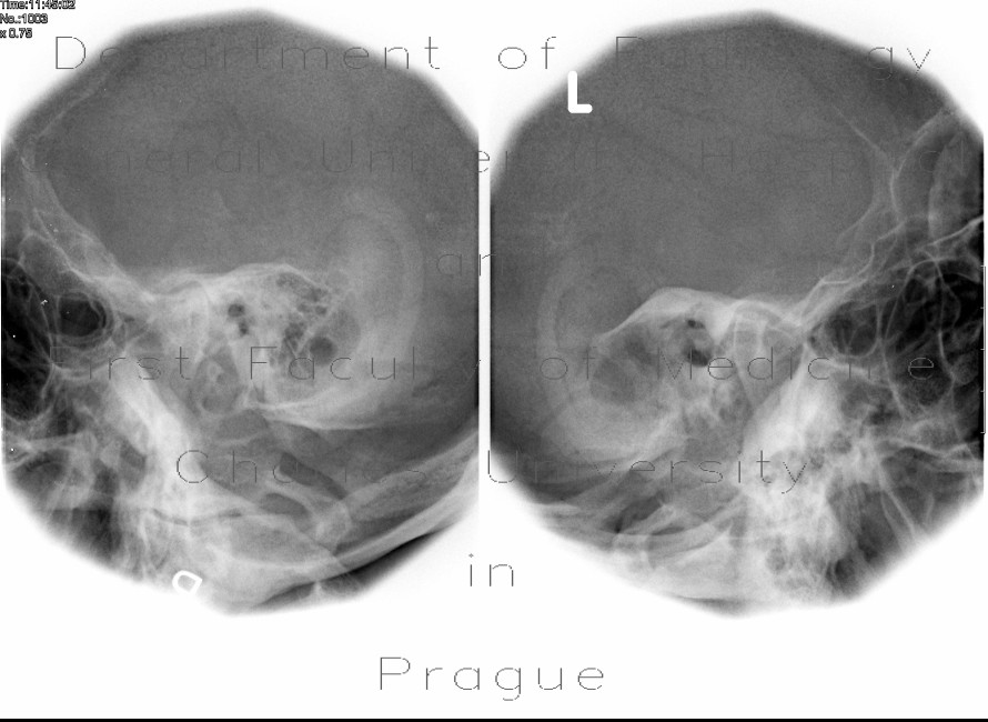 Rundstrom view, chronic mastoiditis